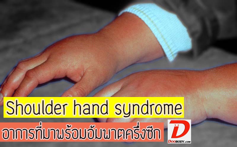 Shoulder hand syndrome  อาการปวดแขนแปลกๆ  ที่มาพร้อมกับอัมพาตครึ่งซีก
